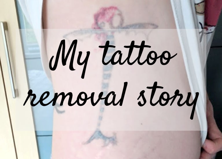 My Tattoo Removal Story, Part Two