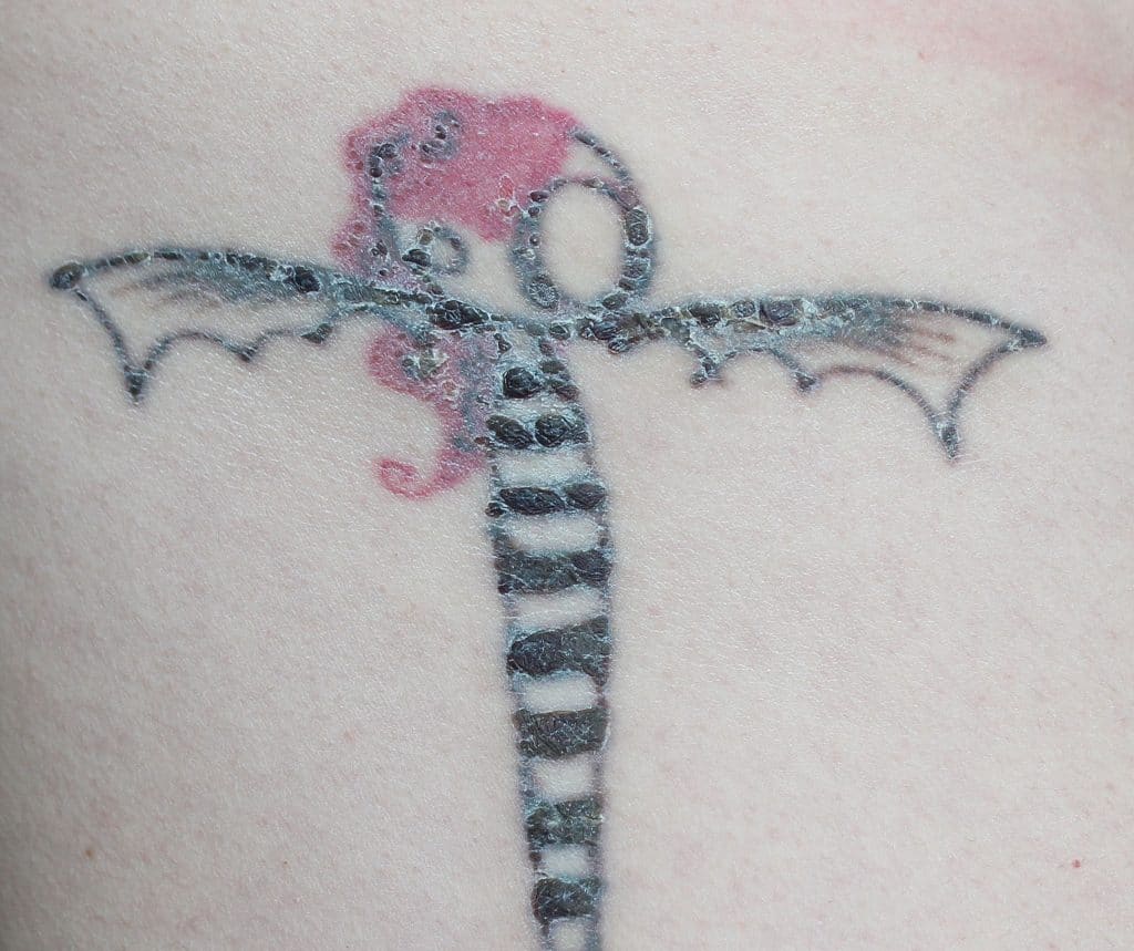 My Tattoo Removal Story, Part Two